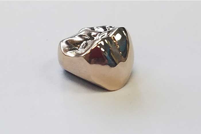 Porcelain fused to metal