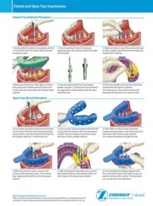 Closed and open tray impression techniques for implants, courtesy of Zimmer Dental