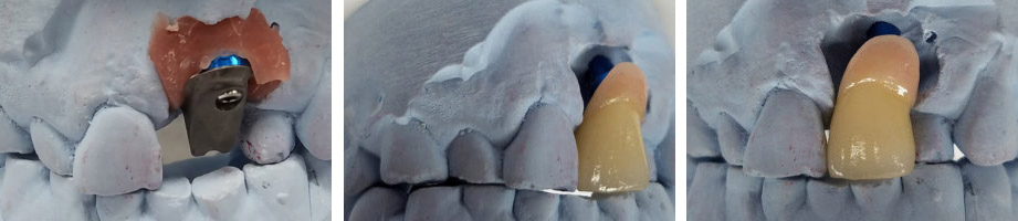 The Porcelain Fused to Metal by Global Dental Solutions at Atlanta, GA