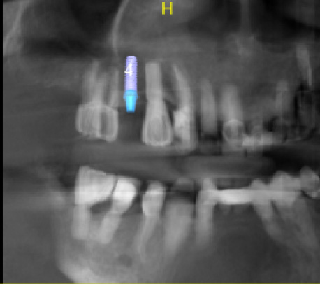 Dental Implant Surgery