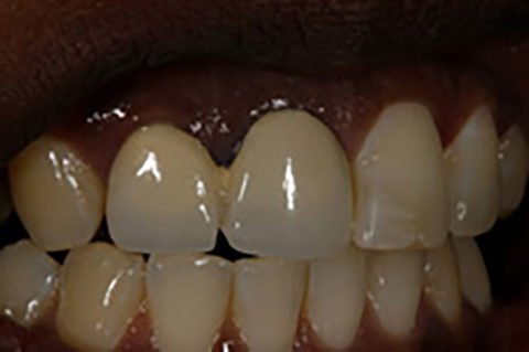 Dental Case Studies at Dental Lab in Atlanta, GA