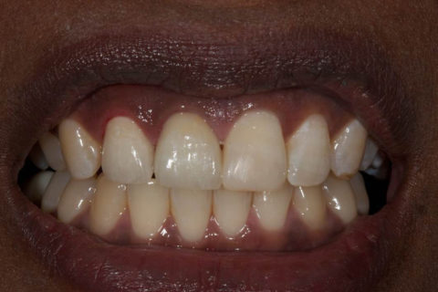 Dental Case Studies at Dental Lab in Atlanta, GA