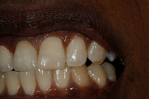 Dental Case Studies at Dental Lab in Atlanta, GA