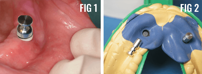  The LOCATOR impression coping Case by Global Dental Solutions at Atlanta, GA