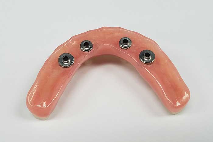 The hybrid denture in screw type at Atlanta, GA