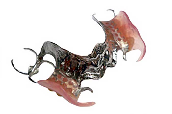 Hybrid Cast/Flexible Partial