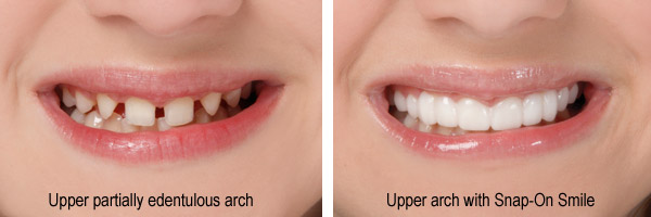 Snap-On Smile