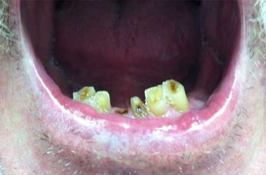 Lower teeth of patient in need of acetal resin overpartial | Global Dental Solutions