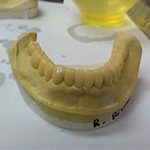 Acetal Resin Overpartials at Global Dental Solutions