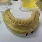 Full Cast Inlay ceramic teeth at Atlanta, GA