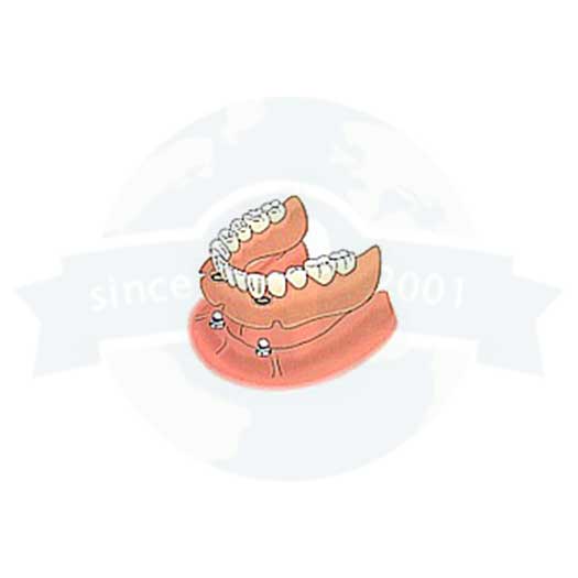 The Model of Custom Root Caps from Global Dental Solutions at Atlanta, GA