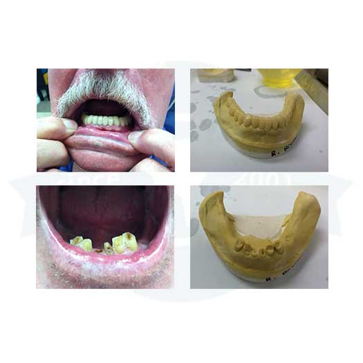 Ceramic Restorations Global Dental Solutions