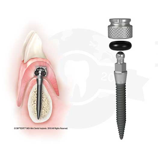 Implant-Supported Dentures: General Practice | Glidewell