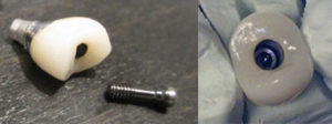 The PFM Screw-Retained Crown And Bridges from Global Dental Solutions at Atlanta, GA