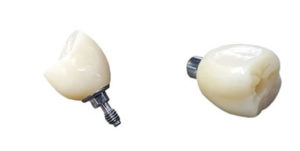 Ceramic Screw-Retained Dentures from Global Dental Solutions