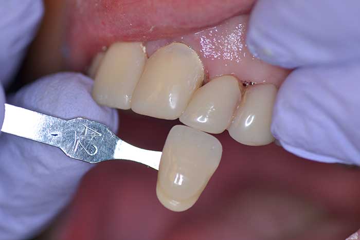 The teeth Shade Matching and fixing for patient in global dental solution at Cheektowaga, NY