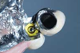 Attachments For Fixed And Removable Dentures at Global Dental Solutions