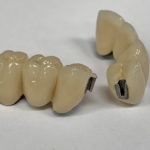 Broken teeth for Tube Attachments from Global Dental Solutions at Atlanta, GA