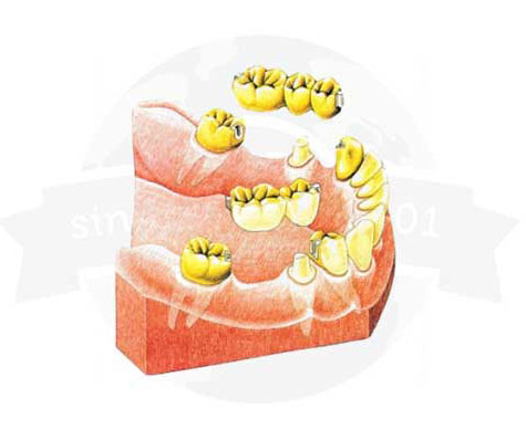 Unparallel Bridge Abutments by Global Dental Solutions