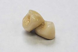 Porcelain Fused To Metal Crown by Global Dental Solutions