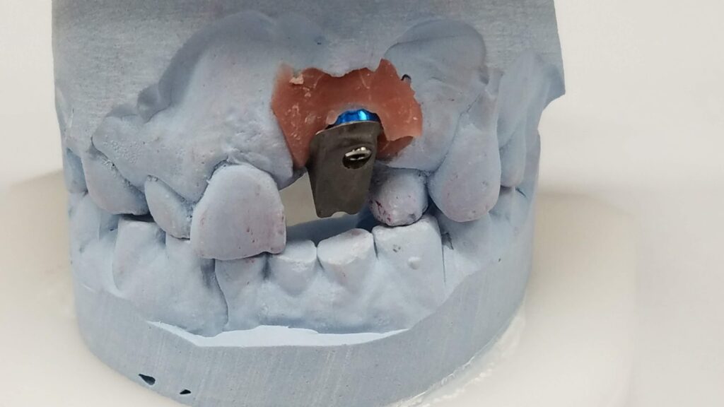 Global Dental Solutions Palatal Obturators Global Dental Solutions Palatal Obturators