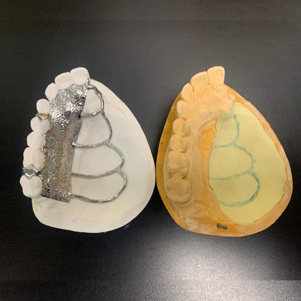 The Framework Design By The Maxillofacial Prosthodontist at Atlanta, GA