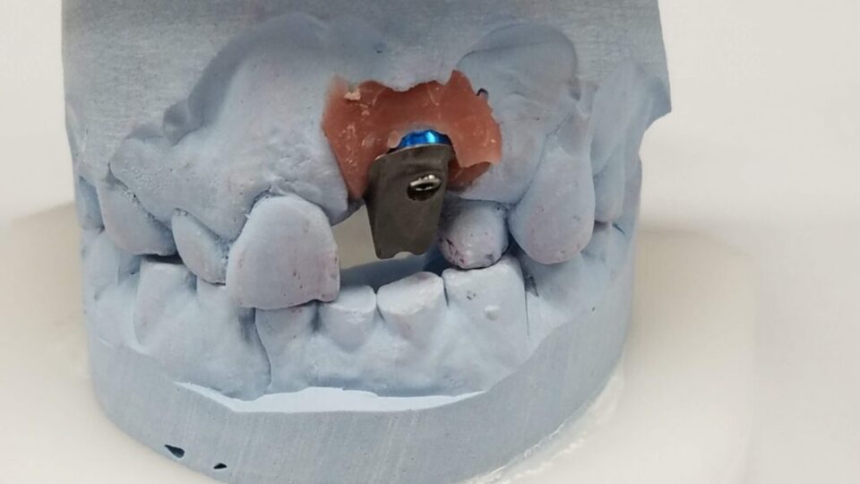 Tissue Shaded Porcelain Cervical and Embrasures