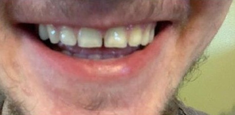 the person smiling with Acetal Resin Over partial teeth at Atlanta, GA