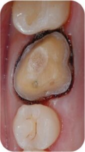 The gingival tissuere traction by global dental solution at Atlanta, GA