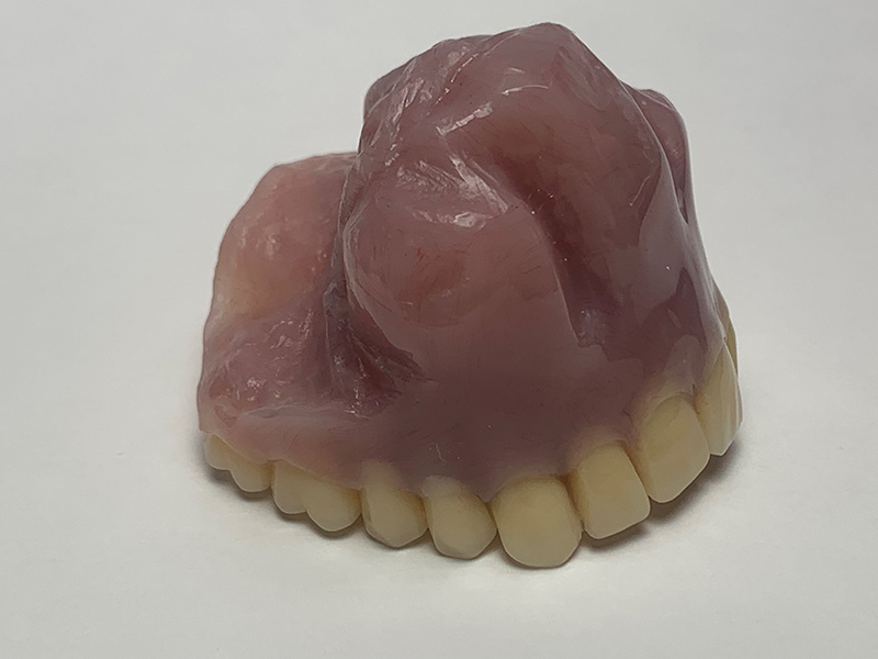 Maxillary Definitive Obturator