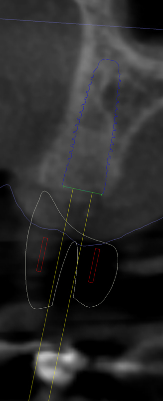 Dental Implant X-ray
