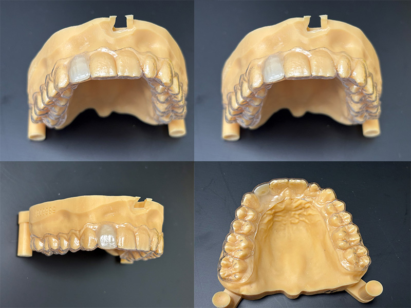 dentures
